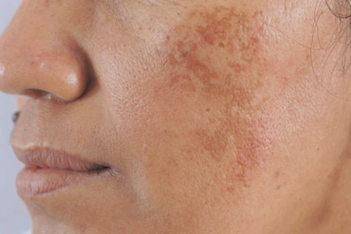 Cảnh báo ung thư: 5 vùng cơ thể đổi màu đen, dấu hiệu sớm nhiều người bỏ qua