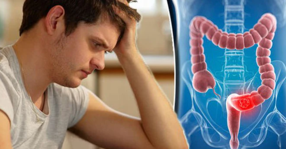 Ngày càng nhiều người trẻ mắc UT đại trực tràng, bác sĩ chỉ đích danh 1 triệu chứng rất hay bị bỏ sót