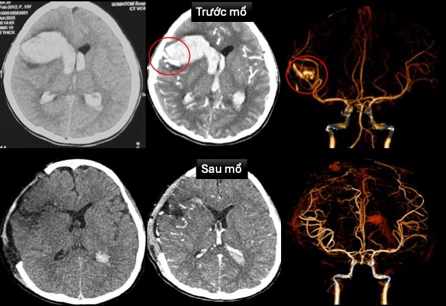 TP.HCM: Bé gái 13 tuổi đôt:quy, xuathuyet não, s:ốc tim khi đang ngủ