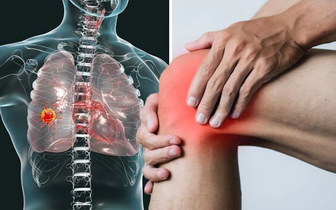 Tưởng đau khớp ai ngờ UT phổi, có những dấu hiệu này ở chân thì cần đi khám gấp